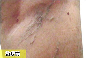 腿部产后漏尿扩张